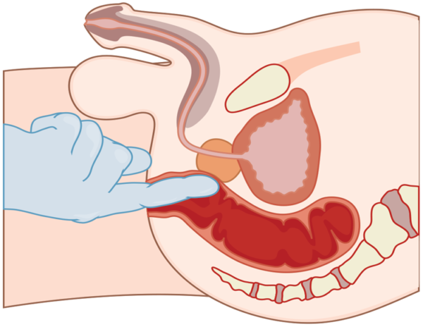 1495024666_tehnika-palcevogo-massazha-prostaty-600x464-1