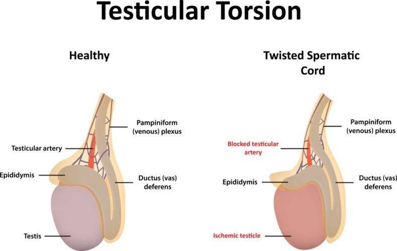 1633-testicular-torsion-e1537870841630-1-2