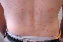 4954-2-pityriasis-rosea-utslett-220x147-1