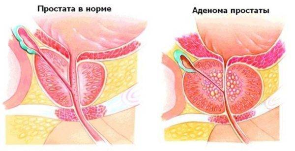 adenoma-predstatelnoj-zhelezy-600x307-1