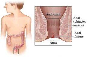 anal-fissure_fig_1-300x192-1