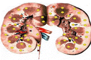 glomerulonefrit-prichiny