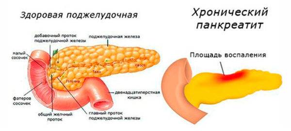 hronicheskij-pankreatit-1-e1523089364505