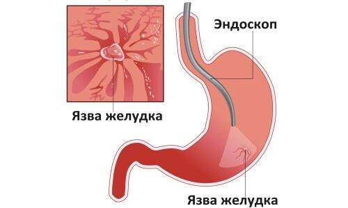 jazvennaja-bolezn-zheludka