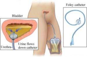 kak-pravilno-postavit-kateter-v-mochevoj-puzyr-zhenshhine-ili-muzhchine-1-300x196-1