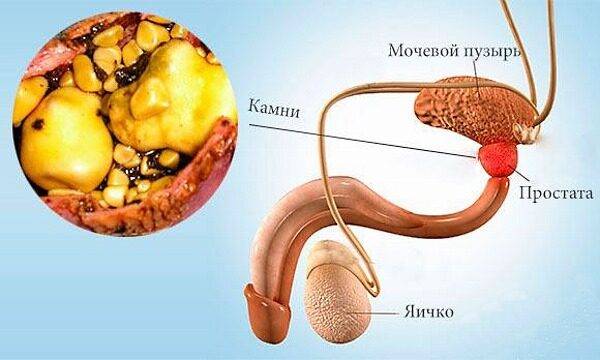 kalcinaty_v_predstatelnoy_zheleze_i_ih_udalenie_2