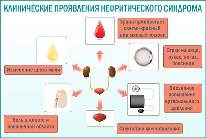 klinicheskie-projavlenija-nefriticheskogo-sindroma