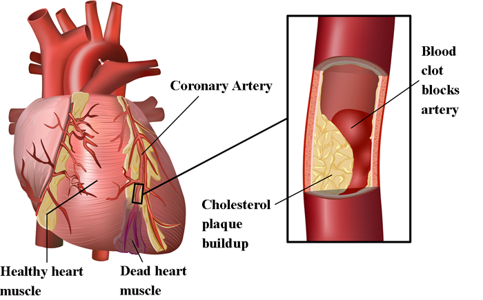 ldl-cholesterol-11