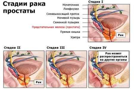 lechitsya_li_rak_prostaty_4_stepeni__1