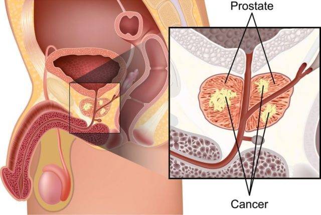 lechitsya_li_rak_prostaty_4_stepeni__2