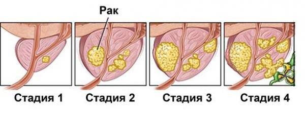 lechitsya_li_rak_prostaty_4_stepeni__4