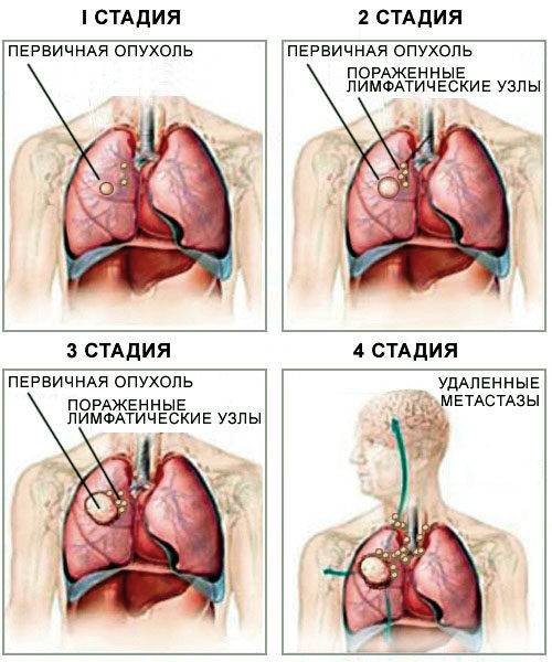 lechitsya_li_rak_prostaty_4_stepeni__5