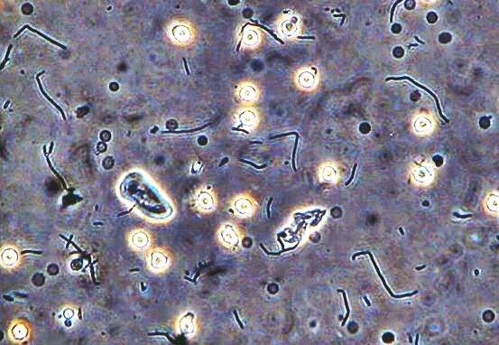 leukocytes-in-urine-2