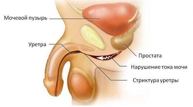 mazok-iz-uretry-u-muzhchin-e1488535437848