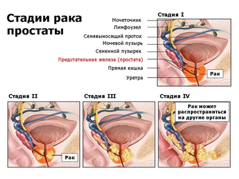 melkoacinarnaja-adenokarcinoma