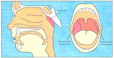 mindaliny_i_adenoidy_1_03103352-400x203-1