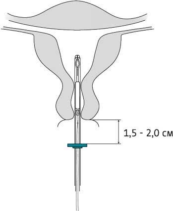 opispr1083