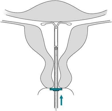 opispr1085