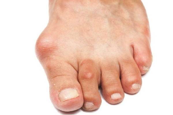 osteoarthritis_of_the_big_toe_1-e1439016627805