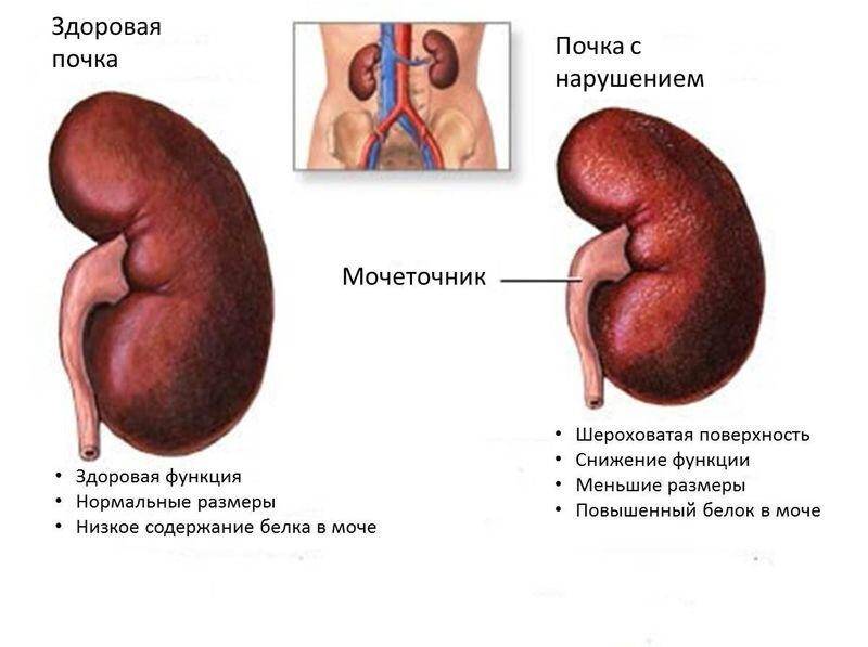 piyelonefrit