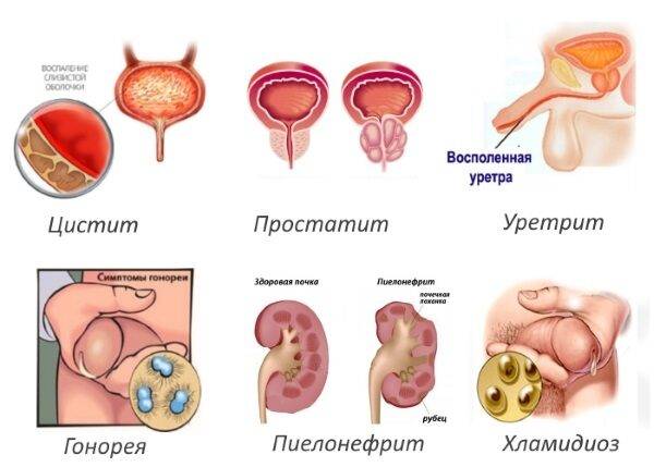 pochemu_poyavlyaetsya_diskomfort_pri_mocheispuskanii_u_muzhchin__4