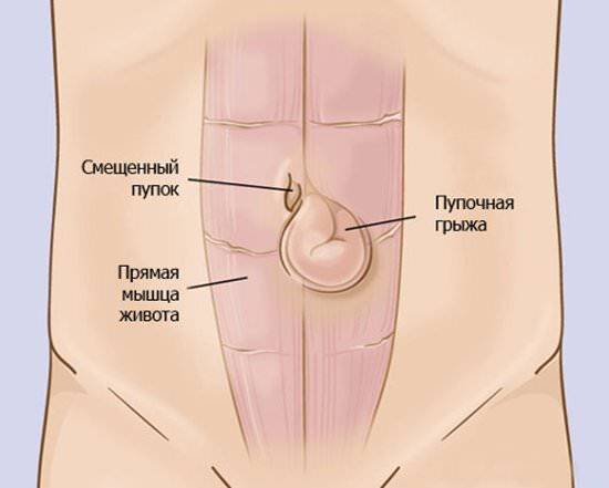 pupochnaya-gryzha-chto-eto