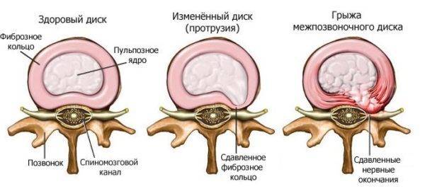 razvitie-mezhpozvonochnoj-gryzhi-600x270-1