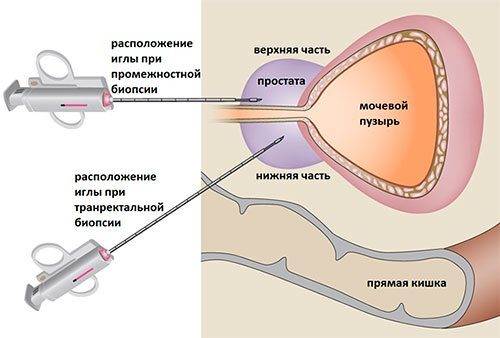 transrektalnaya-biopsiya-prostaty