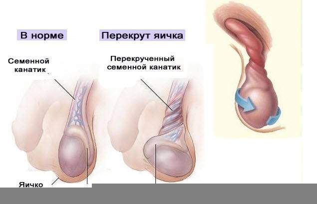 uvelichenie_yaichka_u_muzhchin_simptomy_i_prichiny_zabolevaniya_1