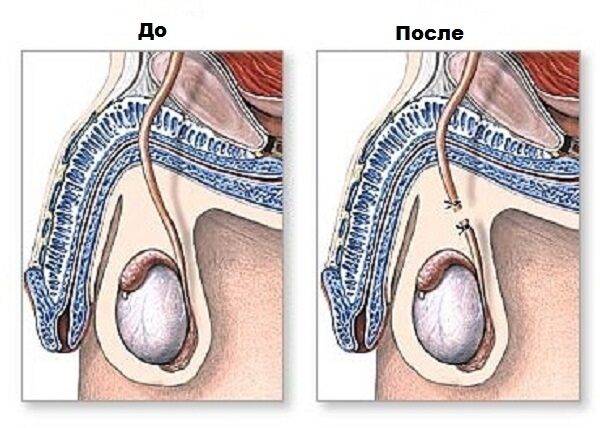 vazektomiya-2