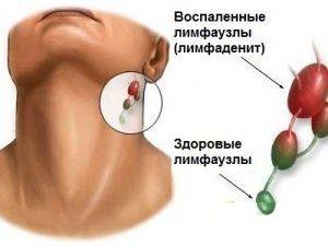 vid-vospalennyh-limfouzlov-300x225-1