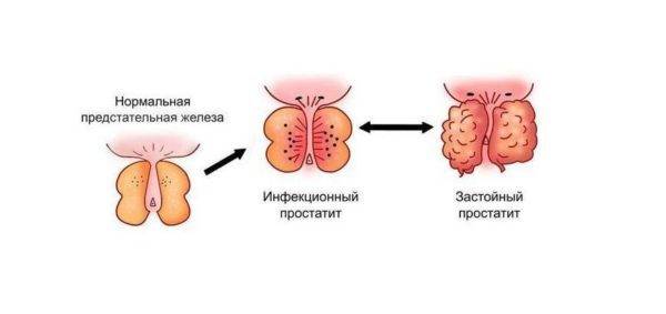 vidy-prostatita-600x283-1