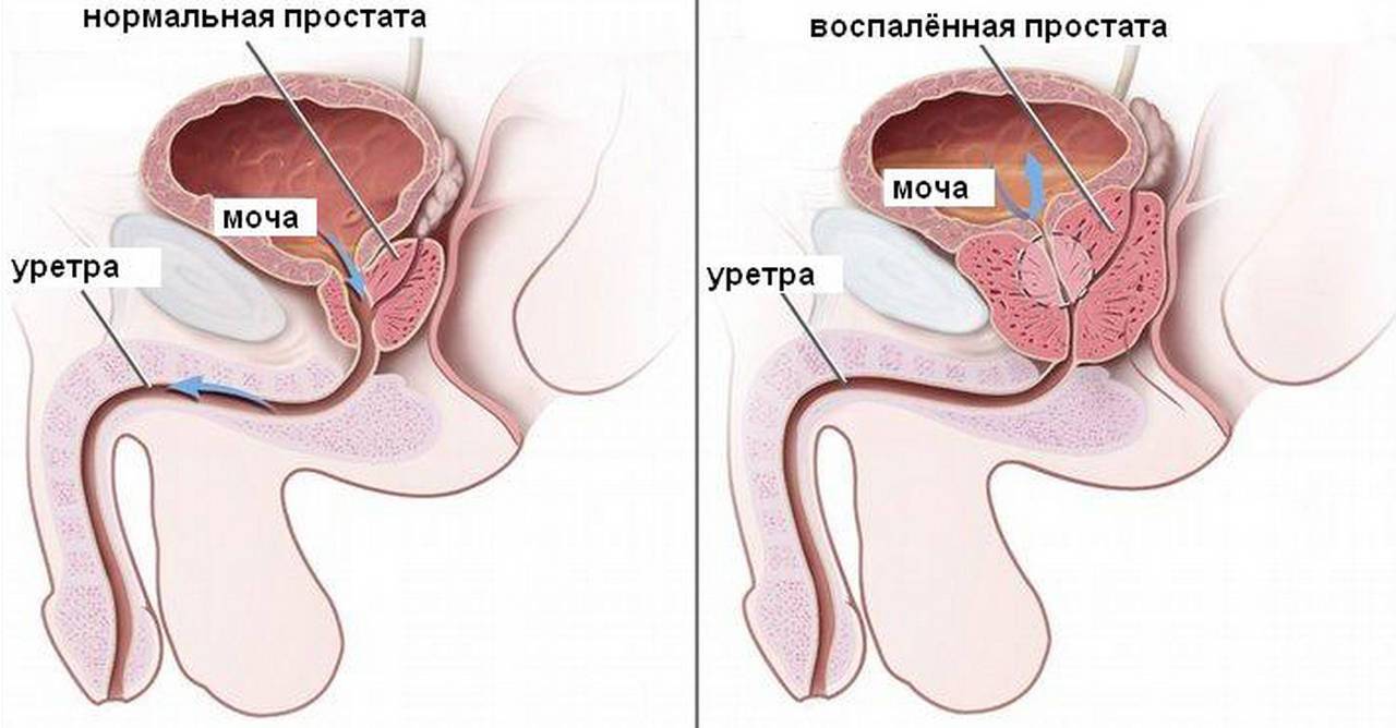 zdorovaya-prostata-razmerom-vsego-s-tolstyj-kashtan-raspolozhena-chut-nizhe-mochevogo-puzyrya