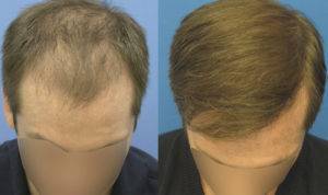 alopecia4-300x178-1