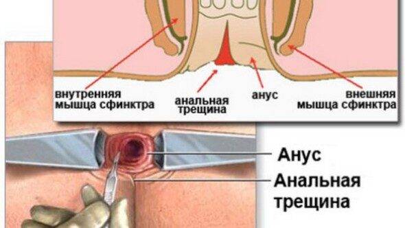 analnaya-treshchina2