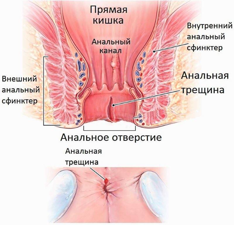 analnye-treschiny-1