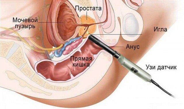 biopsiya-prostati