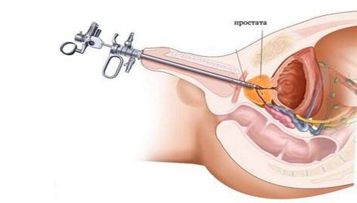 biopsiya-prostaty-pokazaniya-vidy-sposob-provedeniya-1