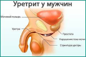 bol-pri-mocheispuskanii-4-300x200-1