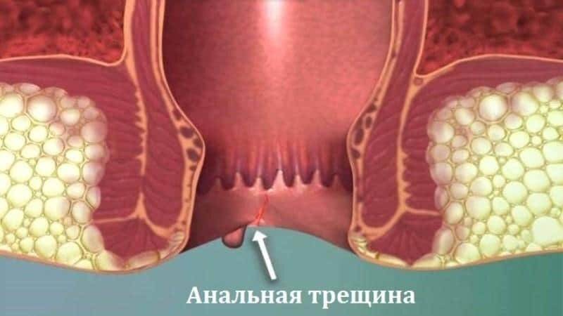 chuvstvo-raspiraniya-v-zadnem-prohode-prichinyi-1