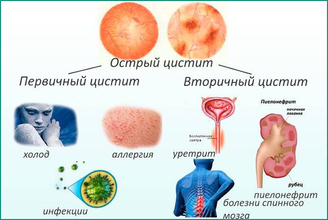 cistit-u-muzhchin-simptomy-4