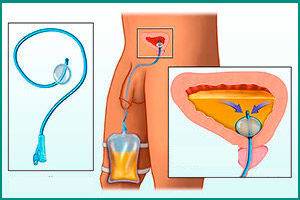 cistit-u-muzhchin-simptomy-5-1-300x200-1