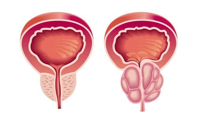 dobrokachestvennaya-giperplaziya-prostaty