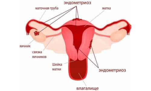 endometriosis-500x300-1