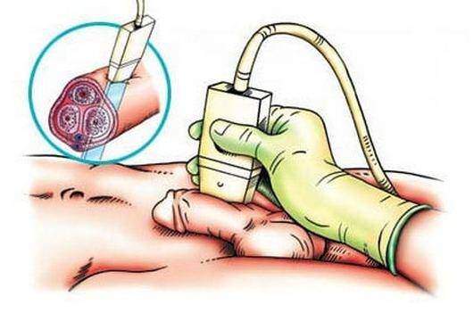 farmakodopplerografiya-sosudov-polovogo-chlena