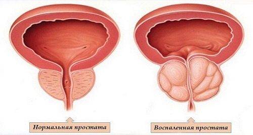 fibroz-prostaty