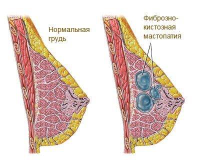 fibrozno-kistoznaya-mastopatiya