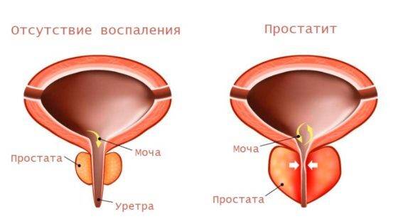 fizicheskie-uprazhneniya-pri-prostatite-i-adenome-prostaty-1-e1517410716997