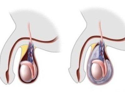 gidrocele-posle-operacii