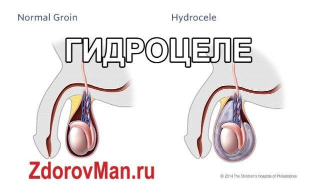 gidrotsele